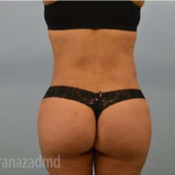Brazilian Butt Lift Before & After Patient #1663