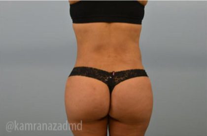 Brazilian Butt Lift Before & After Patient #1663