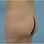 Brazilian Butt Lift Before & After Patient #1665