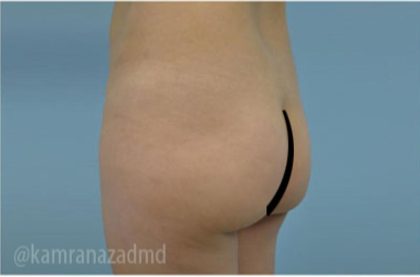 Brazilian Butt Lift Before & After Patient #1665