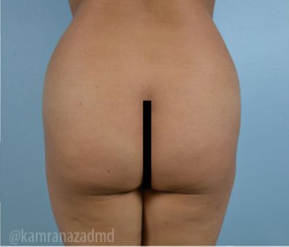 Brazilian Butt Lift Before & After Patient #1666
