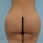 Brazilian Butt Lift Before & After Patient #1666