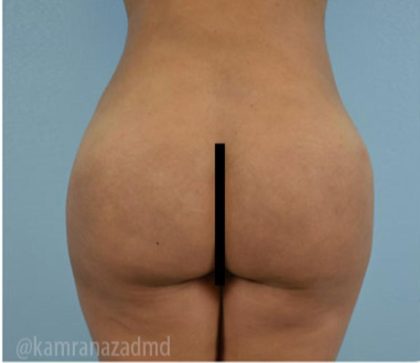 Brazilian Butt Lift Before & After Patient #1666
