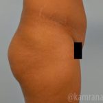 Brazilian Butt Lift Before & After Patient #1668