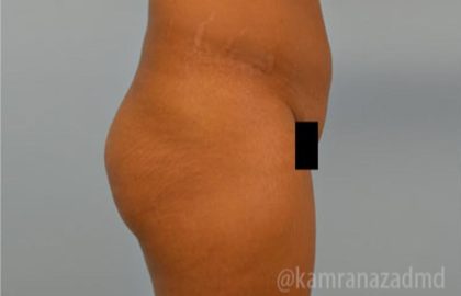 Brazilian Butt Lift Before & After Patient #1668