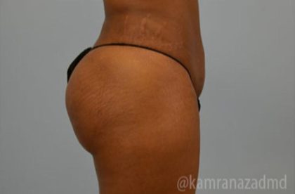 Brazilian Butt Lift Before & After Patient #1668