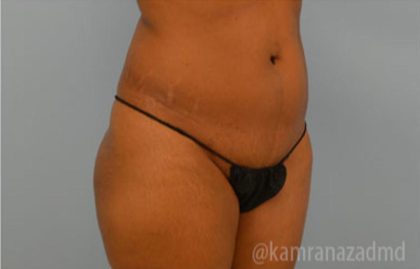 Brazilian Butt Lift Before & After Patient #1668