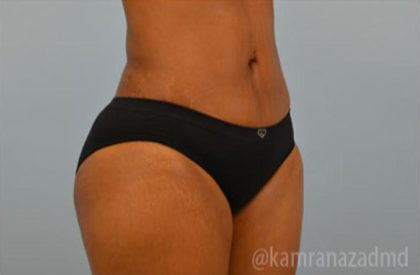Brazilian Butt Lift Before & After Patient #1668