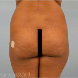 Brazilian Butt Lift Before & After Patient #1668