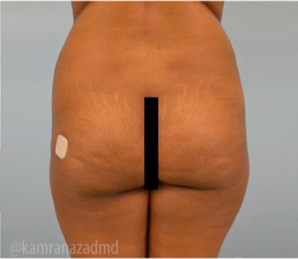 Brazilian Butt Lift Before & After Patient #1668