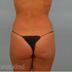 Brazilian Butt Lift Before & After Patient #1670