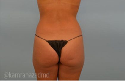 Brazilian Butt Lift Before & After Patient #1670
