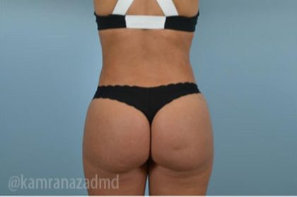 Brazilian Butt Lift Before & After Patient #1670