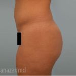Brazilian Butt Lift Before & After Patient #1670