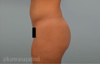 Brazilian Butt Lift Before & After Patient #1670
