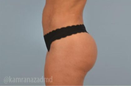 Brazilian Butt Lift Before & After Patient #1670