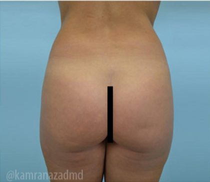 Brazilian Butt Lift Before & After Patient #1670