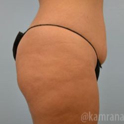Brazilian Butt Lift Before & After Patient #1671