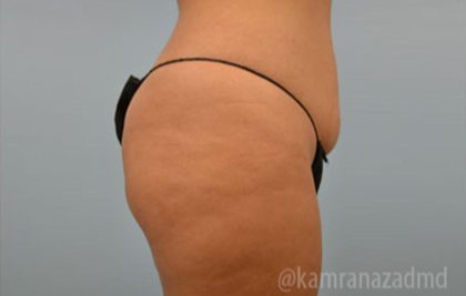 Brazilian Butt Lift Before & After Patient #1671