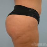 Brazilian Butt Lift Before & After Patient #1671