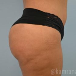 Brazilian Butt Lift Before & After Patient #1671