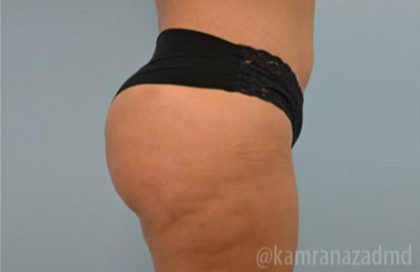 Brazilian Butt Lift Before & After Patient #1671