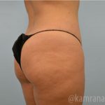 Brazilian Butt Lift Before & After Patient #1671