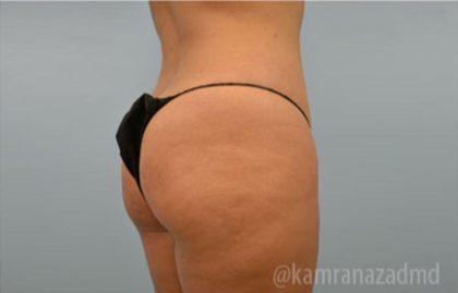 Brazilian Butt Lift Before & After Patient #1671
