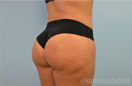 Brazilian Butt Lift Before & After Patient #1671