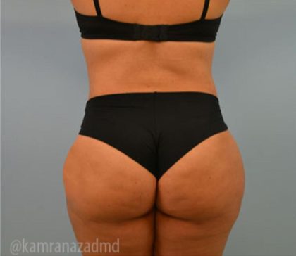 Brazilian Butt Lift Before & After Patient #1671