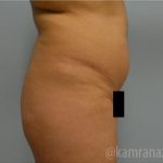 Brazilian Butt Lift Before & After Patient #1673