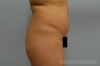 Brazilian Butt Lift Before & After Patient #1673