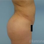 Brazilian Butt Lift Before & After Patient #1673