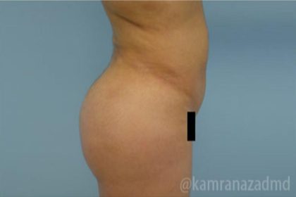 Brazilian Butt Lift Before & After Patient #1673
