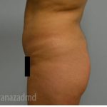 Brazilian Butt Lift Before & After Patient #1673