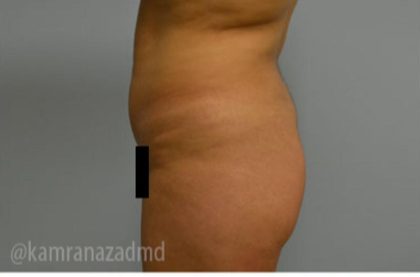 Brazilian Butt Lift Before & After Patient #1673