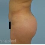 Brazilian Butt Lift Before & After Patient #1673