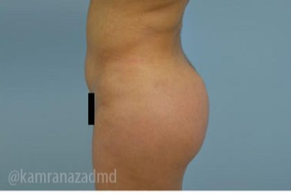 Brazilian Butt Lift Before & After Patient #1673