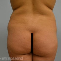 Brazilian Butt Lift Before & After Patient #1673