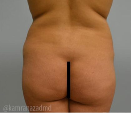 Brazilian Butt Lift Before & After Patient #1673