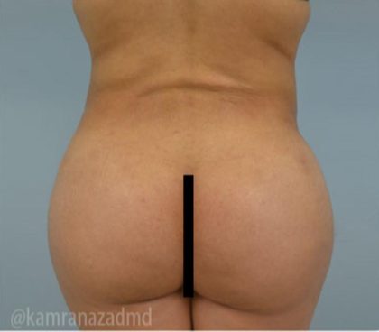 Brazilian Butt Lift Before & After Patient #1673