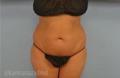 Brazilian Butt Lift Before & After Patient #1675