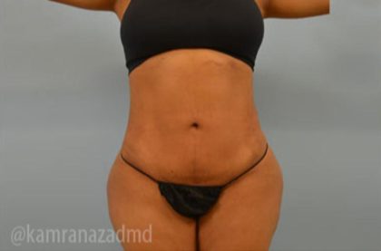 Brazilian Butt Lift Before & After Patient #1675
