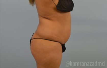 Brazilian Butt Lift Before & After Patient #1675