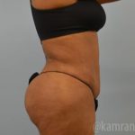 Brazilian Butt Lift Before & After Patient #1675
