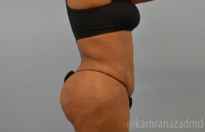 Brazilian Butt Lift Before & After Patient #1675