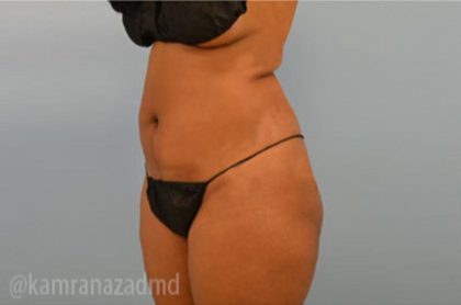 Brazilian Butt Lift Before & After Patient #1676