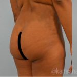 Brazilian Butt Lift Before & After Patient #1676