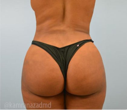 Brazilian Butt Lift Before & After Patient #1676