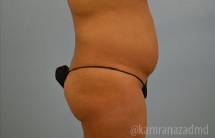 Brazilian Butt Lift Before & After Patient #1678